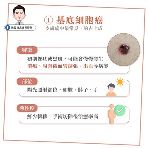 臉頰長痣|皮膚長痣、長斑是皮膚癌前兆？皮膚癌初期4大症狀快。